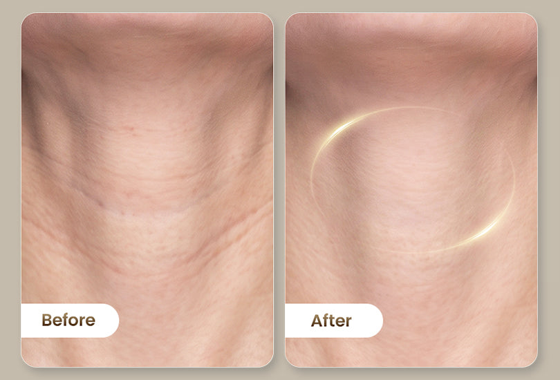 Before-and-after comparison showing smoother-looking neck skin with softened-looking lines.