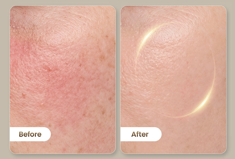 Before-and-after comparison showing clearer-looking skin with visibly reduced redness and uneven tone.