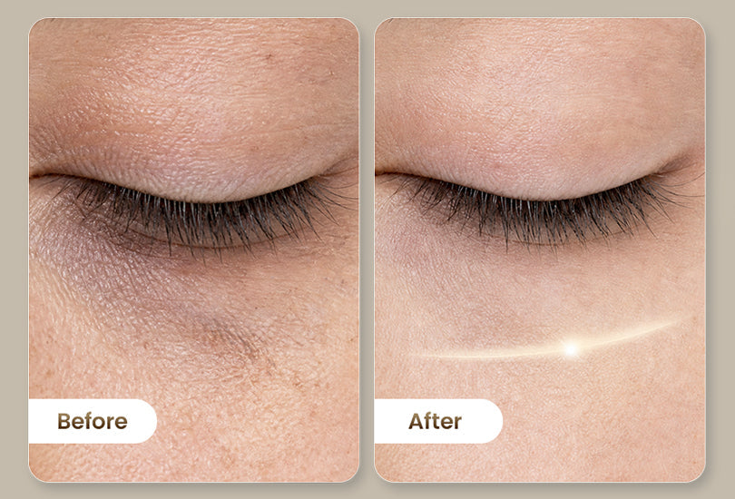 Before-and-after comparison showing a brighter, more refreshed-looking under-eye area.